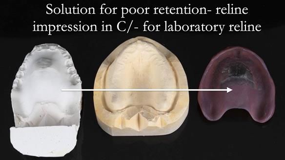 Newsletter 53 showing the making and fitting of ultra life-like dentures for Valena
