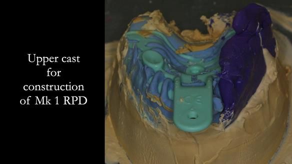 Newsletter 51 Managing Anne’s failing dentition with distal extension base RPD/Splint FULL PROTOCOL