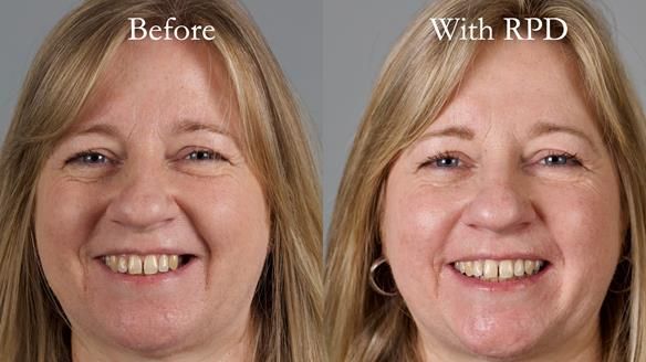 Solving Sue's failed implants with metal based RPD - full protocol Newsletter 43