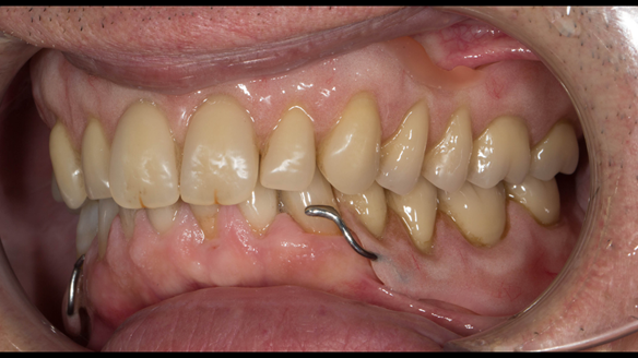 Figure 56 Ufi Gel chair-side reline of upper Mk 1 denture - showing infill of flange UL45 frenum region