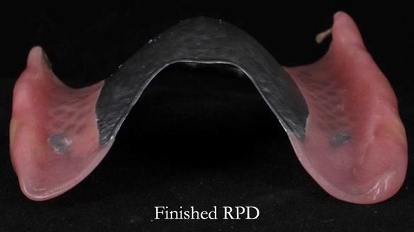Newsletter 56 showing the making and fitting of a bilateral free end saddle upper removable partial denture (RPD) for patient with pemphigus