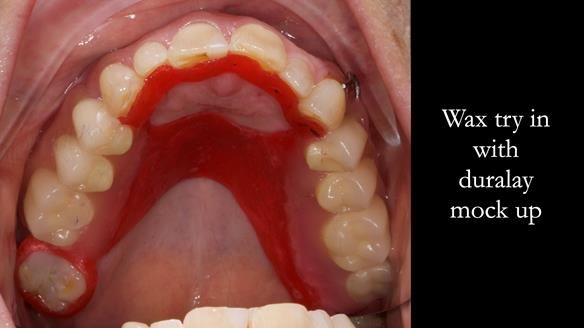 Finlay's Newsletter 60 Sylvia's upper Kennedy Class 2 Mod 1 metal based upper RPD