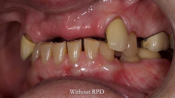 Newsletter 81 - Pam’s Story — how a partial denture changed her life (+ live walkthrough this Thursday)