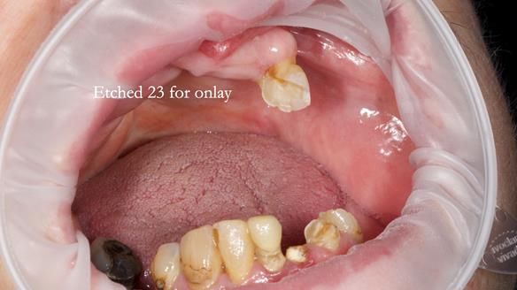Newsletter 55 Provision of metal based partial dentures for Zephyrine with a repaired cleft lip and palate