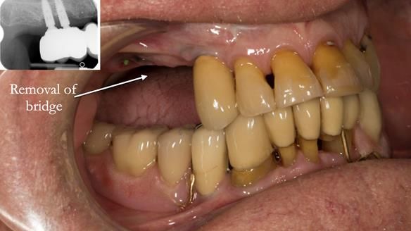 Ken – going downhill, first class