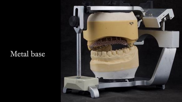 Upper metal base partial denture/occlusal stabilisation splint/obturator - full protocol