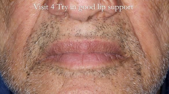 Managing poor implant positioning with complete dentures and Locator attachments - full protocol Newsletter 41