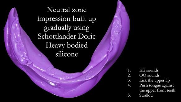 Replacing Madeline’s Complete denture FULL PROTOCOL
