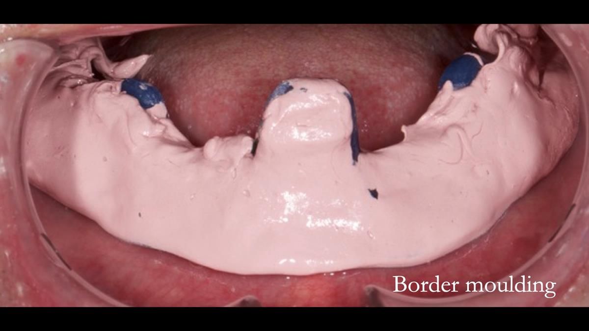 Fin’s Newsletter 88 — Complete dentures - full protocol… he rearranged his own teeth!