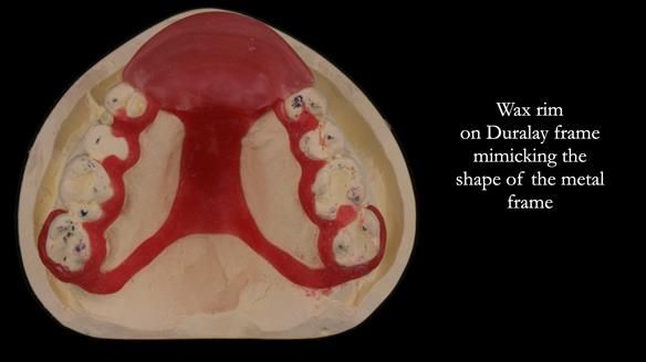 Finlay's Newsletter 63 Case study provision of metal based Scandinavian RPD - functional 10 years on