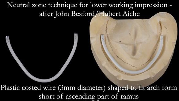 Replacing Madeline’s Complete denture FULL PROTOCOL