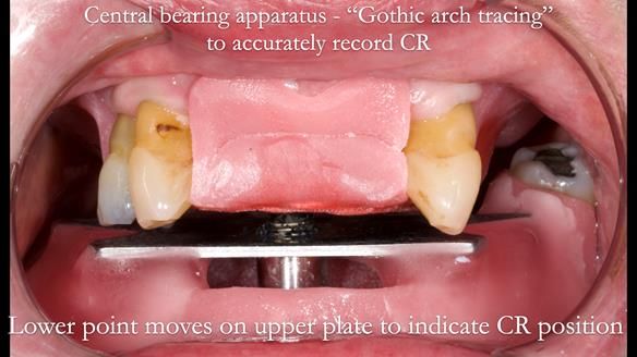 Finlay's Newsletter 59 Ultra hard partial dentures made for Gill