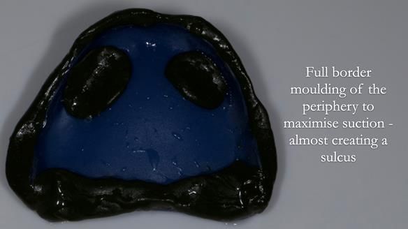 Newsletter 83: Sheila’s Complete Denture Success