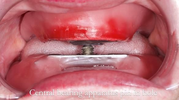 Replacing Madeline’s Complete denture FULL PROTOCOL