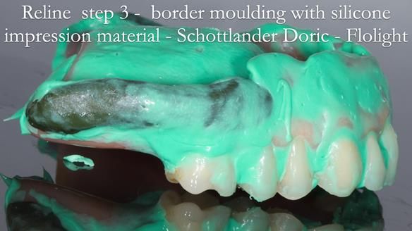 Newsletter 54 case presentation upper complete denture and lower Scandinavian designed hygienic partial denture for David