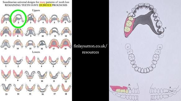 Finlay's Newsletter 64 case study - provision of a Kennedy class 2 metal based Scandinavian RPD for Ian