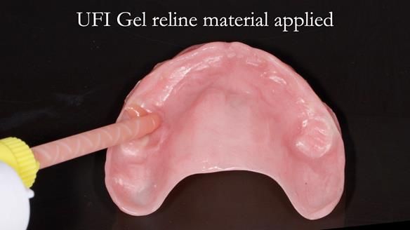 Newsletter 52 Managing Jo’s failing dentition with extractions and Mk 1/Mk 2 complete upper dentures and lower partial dentures FULL PROTOCOL
