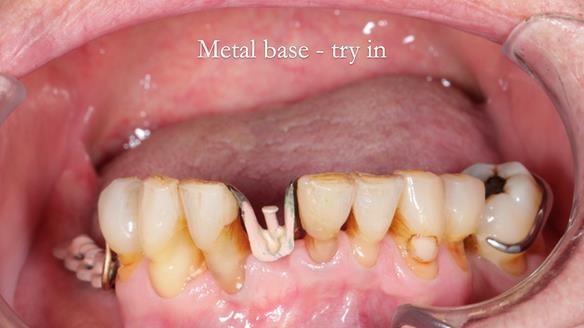 Newsletter 54 case presentation upper complete denture and lower Scandinavian designed hygienic partial denture for David