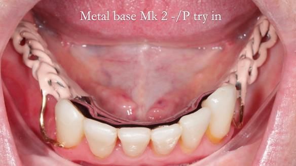 Newsletter 52 Managing Jo’s failing dentition with extractions and Mk 1/Mk 2 complete upper dentures and lower partial dentures FULL PROTOCOL