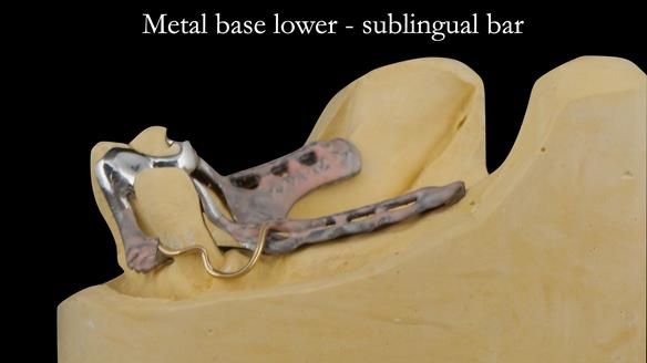 Finlay's Case Study Newsletter 40 - Immediate Mk 1 RPD to Definitive Mk 2 RPD - full protocol