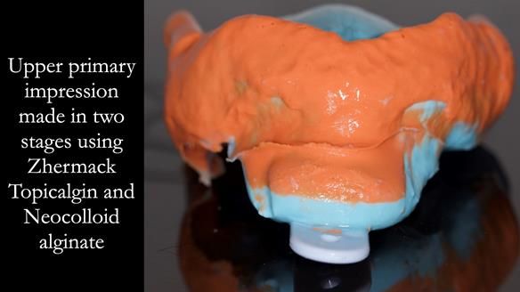 Managing poor implant positioning with complete dentures and Locator attachments - full protocol Newsletter 41