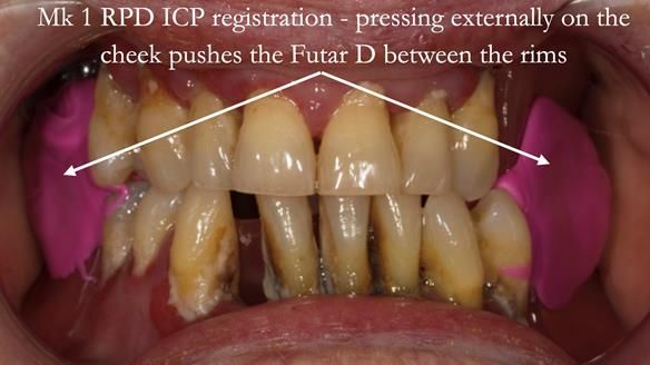 Finlay's Case Study Newsletter 40 - Immediate Mk 1 RPD to Definitive Mk 2 RPD - full protocol