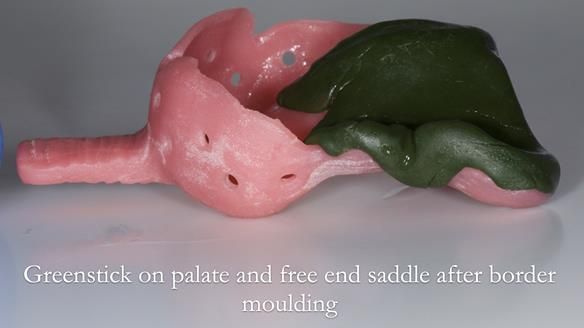 Finlay's Newsletter 60 Sylvia's upper Kennedy Class 2 Mod 1 metal based upper RPD