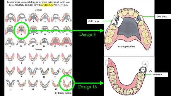 Finlay's Newsletter 59 Ultra hard partial dentures made for Gill