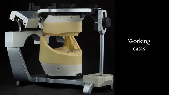 Working casts - class III skeletal relationship