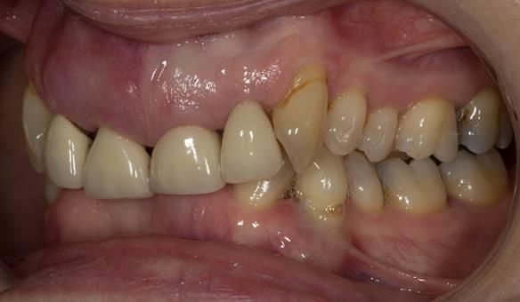 Figure 5 Overeruption of the upper and lower anterior segments with traumatic overbite and aesthetic failure