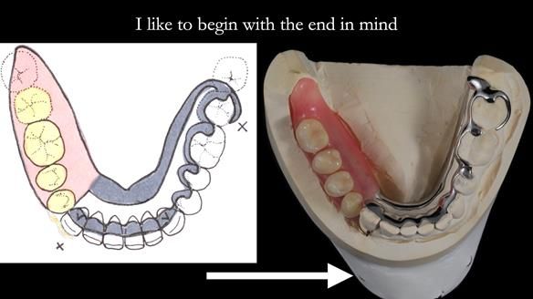 Finlay's Newsletter 61 provision of a lower unilateral free end saddle metal based partial denture for Joyce