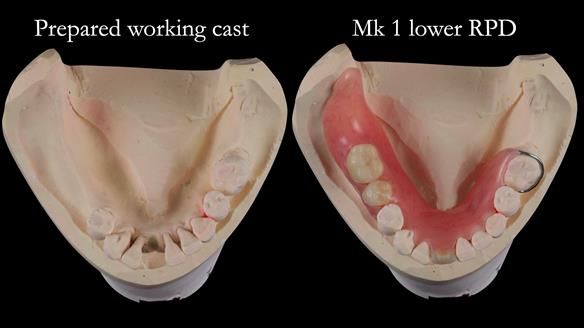 Newsletter 54 case presentation upper complete denture and lower Scandinavian designed hygienic partial denture for David
