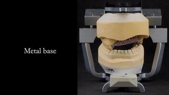 Upper metal base partial denture/occlusal stabilisation splint/obturator - full protocol