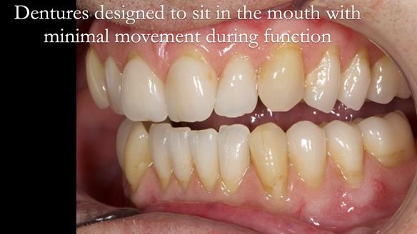 Newsletter 50 Special edition Complete Dentures FULL PROTOCOL