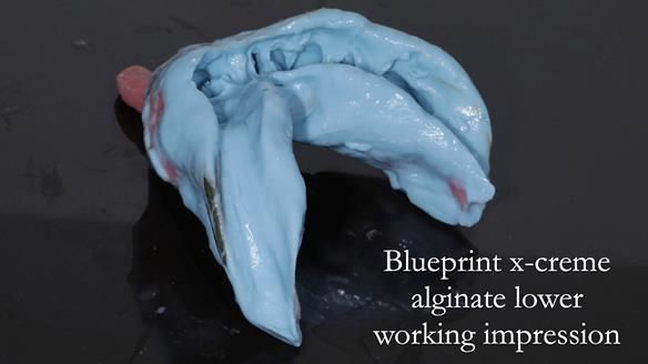 Newsletter 54 case presentation upper complete denture and lower Scandinavian designed hygienic partial denture for David