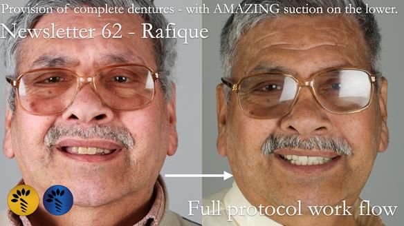 Finlay's Newsletter 62 provision of extractions and metal based complete dentures for Rafique
