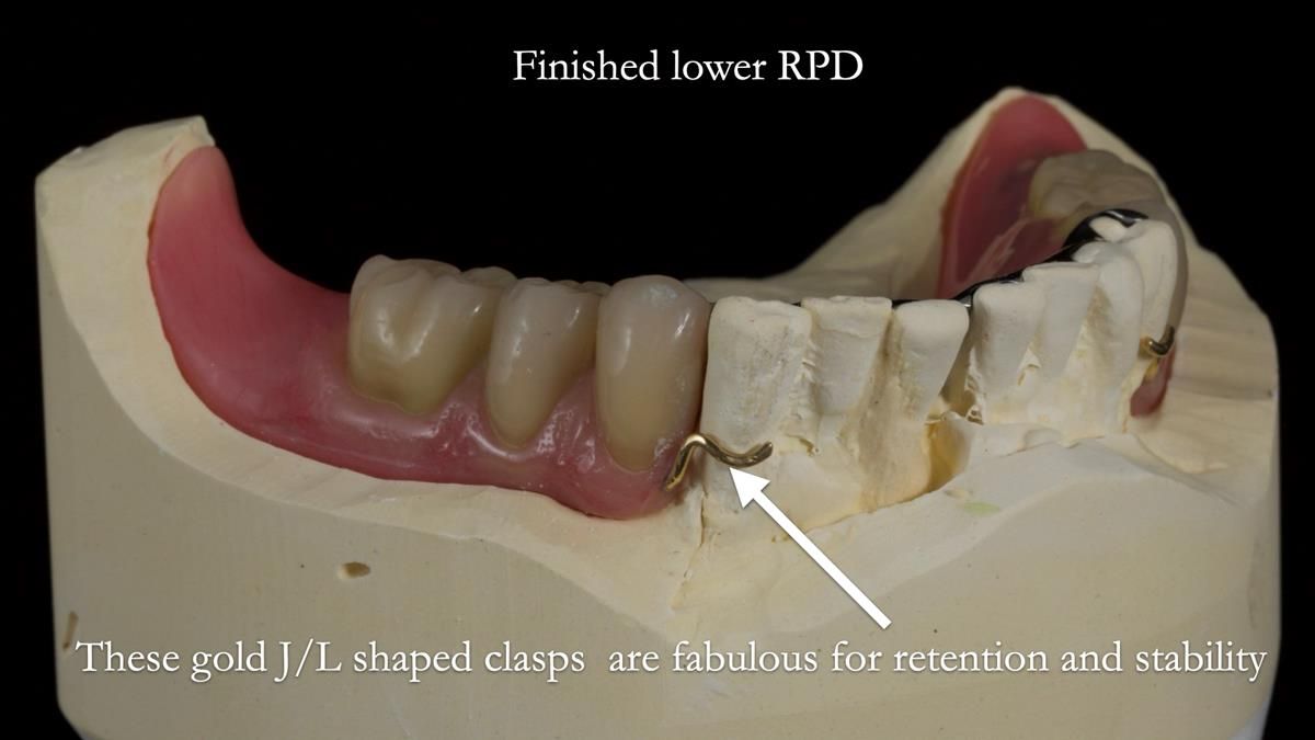 Newsletter 87 – Father Peter: A Partial Denture that needed Minor Miracle