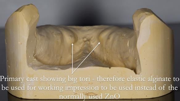 Newsletter 53 showing the making and fitting of ultra life-like dentures for Valena