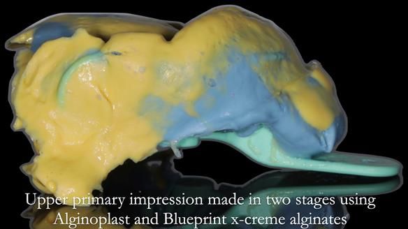 Finlay's Newsletter 58 Gasket upper partial denture for Zoe