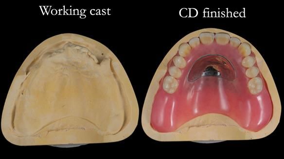Finlay's Newsletter 62 provision of extractions and metal based complete dentures for Rafique