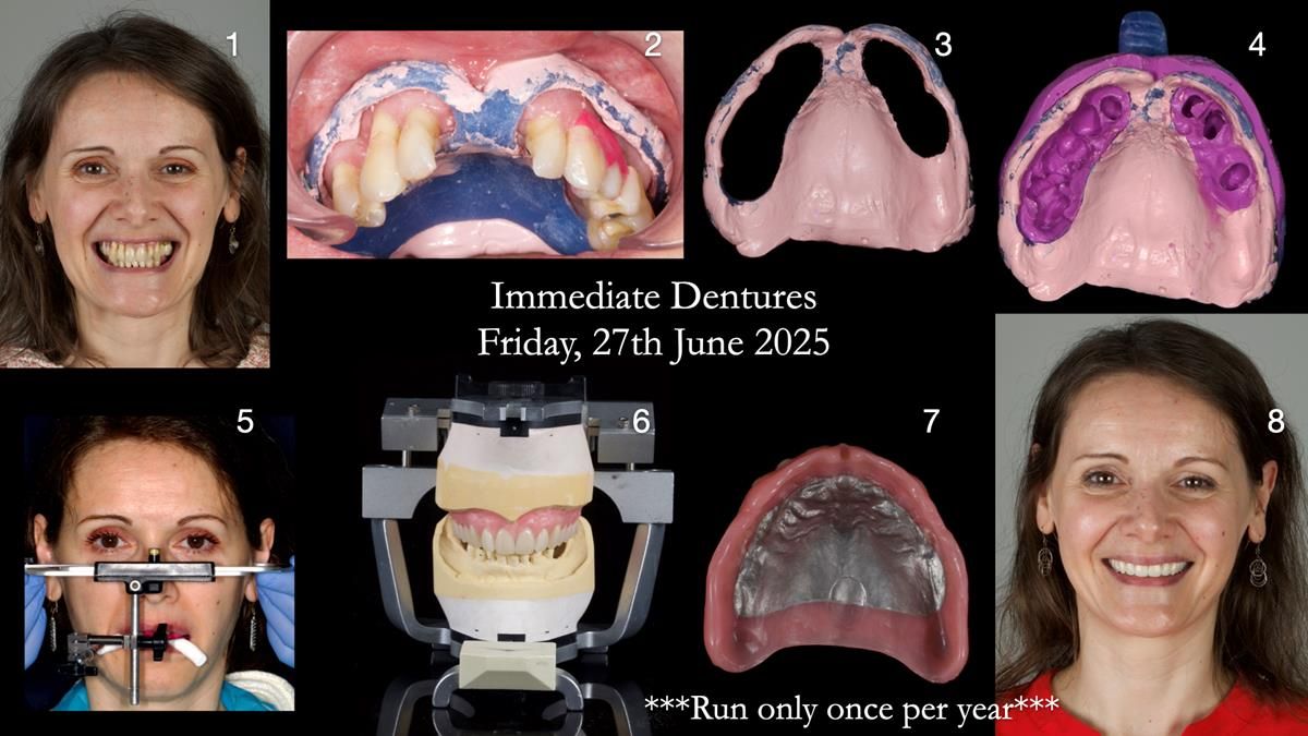 Newsletter 78: What do Clark Gable and a Locator® overdenture have in common?