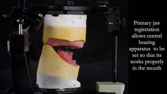 Newsletter 53 showing the making and fitting of ultra life-like dentures for Valena