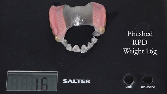 Newsletter 56 showing the making and fitting of a bilateral free end saddle upper removable partial denture (RPD) for patient with pemphigus