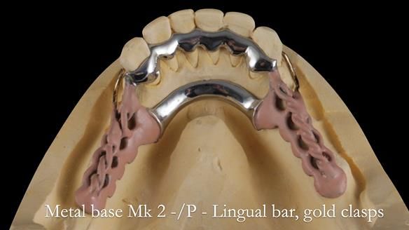 Newsletter 52 Managing Jo’s failing dentition with extractions and Mk 1/Mk 2 complete upper dentures and lower partial dentures FULL PROTOCOL