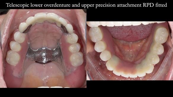 Newsletter 76: Jackie’s case – Telescopic overdenture & precision RPD (the tricky truth!)