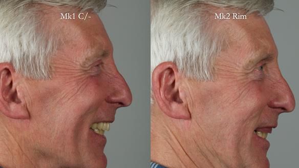 Newsletter 77: Jeremy’s case – immediate complete upper denture