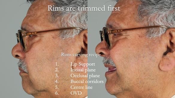 Finlay's Newsletter 62 provision of extractions and metal based complete dentures for Rafique