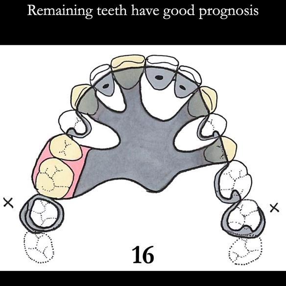 Universal Scandinavian partial denture designs