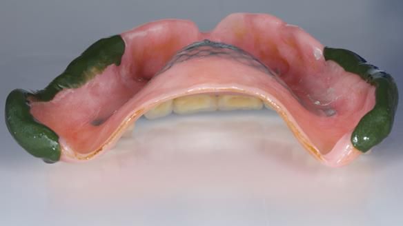 Newsletter 54 case presentation upper complete denture and lower Scandinavian designed hygienic partial denture for David