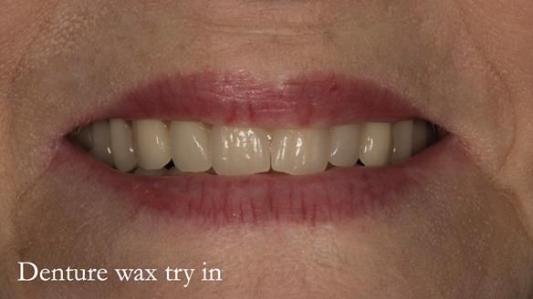 Newsletter 75: Marion’s case - Step-by-step complete denture workflow
